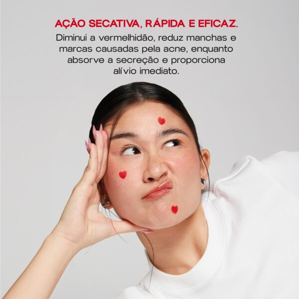 Adesivos Secativos para Espinhas - Bye Bye Acne - Image 2
